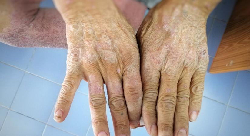 Kemény, érdes bőr: nem szimpla bőrbetegség, ha scleroderma okozza